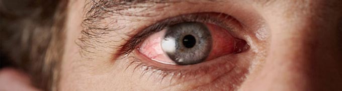 Диагностика конъюнктивита