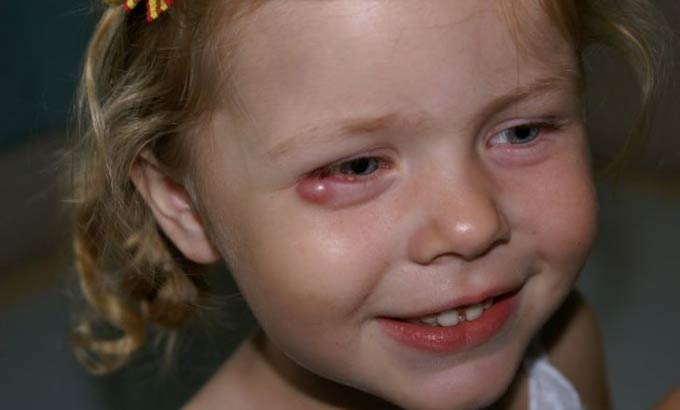 ячмень на веке у ребенка