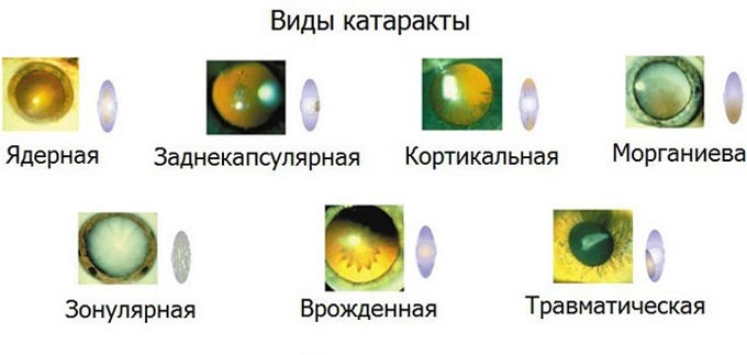 осложнения после катаракты