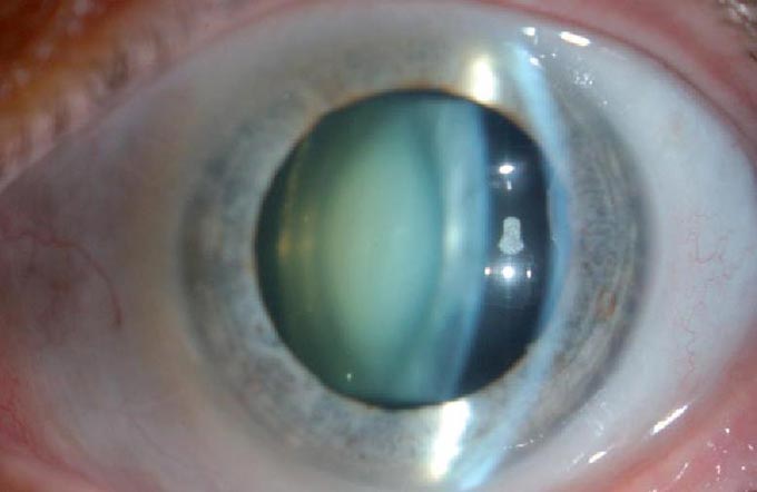 операция при ядерной катаракте