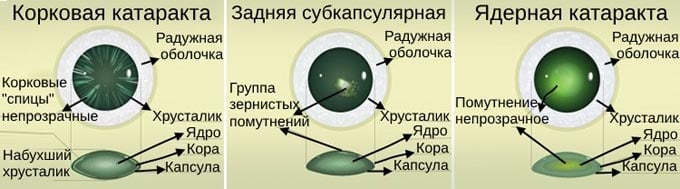 разновидности катаракты