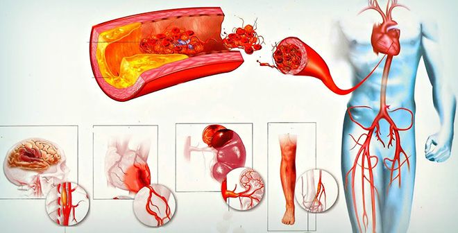 что такое атеросклероз аорты что такое атеросклероз аорты