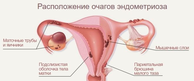 что такое эндометриоз матки у женщин что такое эндометриоз матки у женщин