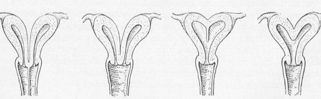 двурогая матка у женщин двурогая матка у женщин