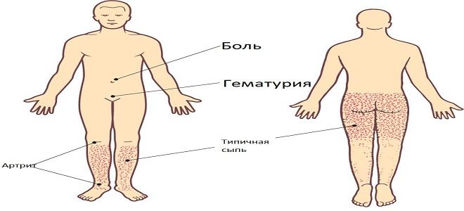 фото1 геморрагическая лихорадка это