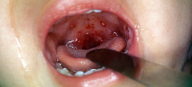 герпетическая ангина у взрослых герпетическая ангина у взрослых