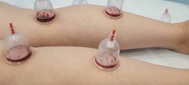 хиджама показания к применению хиджама показания к применению