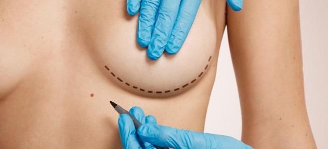 Как делают подтяжку груди Как делают подтяжку груди