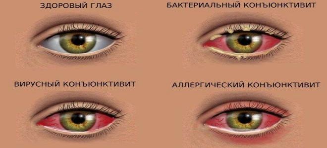 капли для лечения конъюнктивита капли для лечения конъюнктивита