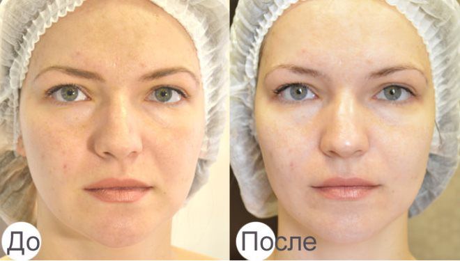 карбокситерапия для лица карбокситерапия для лица