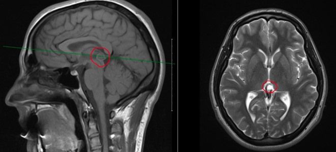 киста эпифиза киста эпифиза