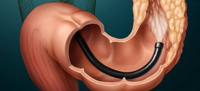 колоноскопия что это за процедура колоноскопия что это за процедура