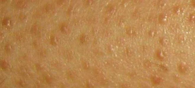 фото1 крапивница на коже