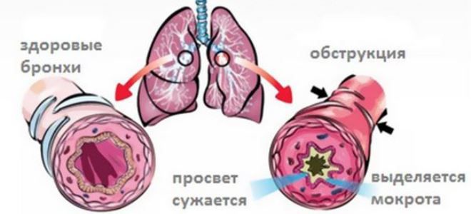 механизм обструкции бронхов механизм обструкции бронхов