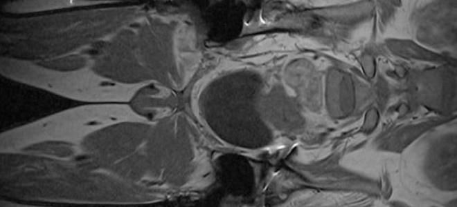 мрт органов малого таза мрт органов малого таза