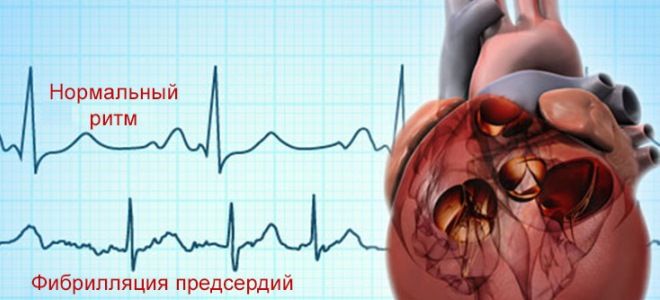 нарушение сердечного ритма нарушение сердечного ритма