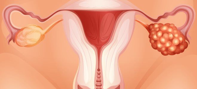 оофорит причины оофорит причины