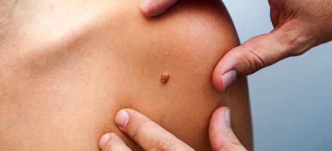 Опасна ли кератома Опасна ли кератома