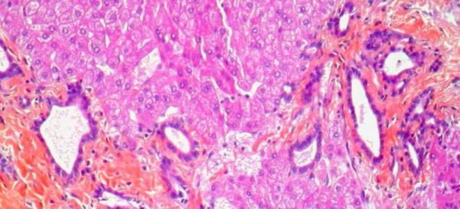 признаки фиброза легких признаки фиброза легких