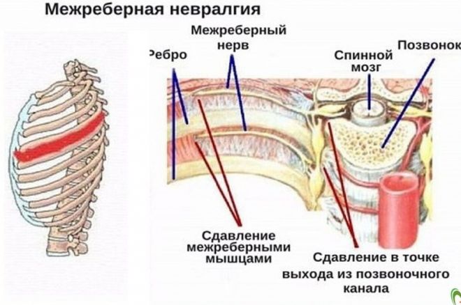 признаки межреберной невралгии признаки межреберной невралгии