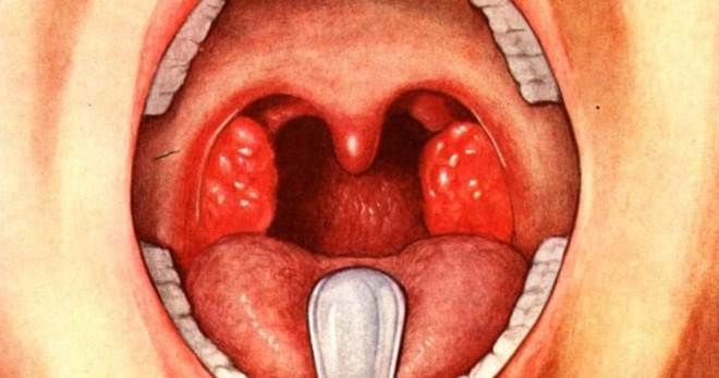 признаки скарлатины признаки скарлатины