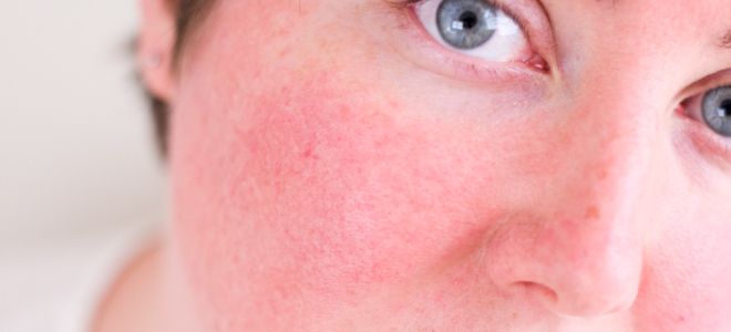 Розацеа формы эритематозная Розацеа формы эритематозная