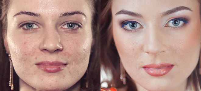 самый лучший крем от прыщей самый лучший крем от прыщей