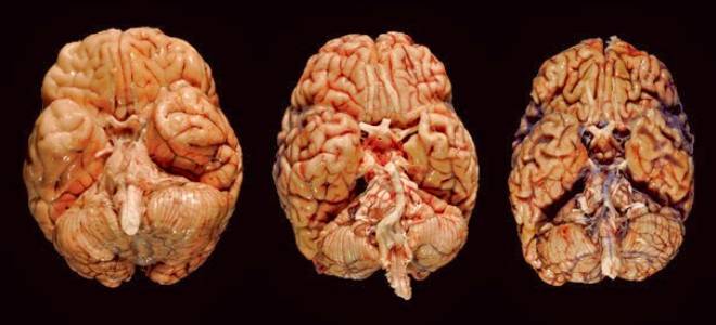 сифилис мозга сифилис мозга