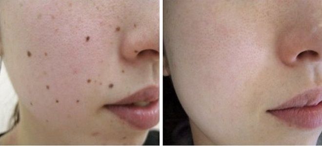 удаление невуса удаление невуса