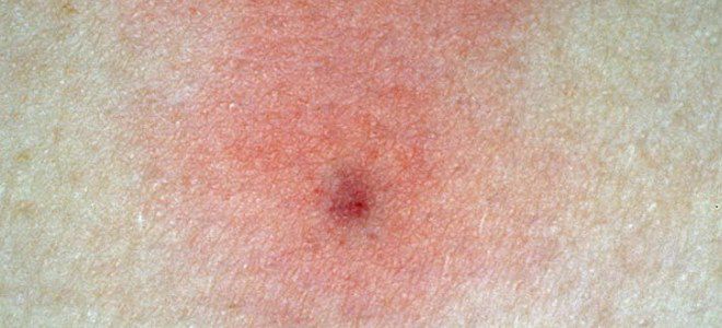 укус клеща у ребенка укус клеща у ребенка