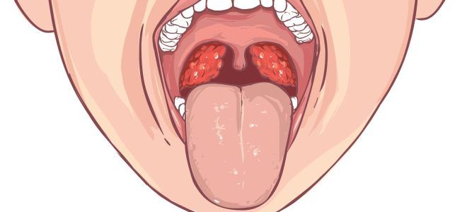 воспаление миндалин у детей воспаление миндалин у детей