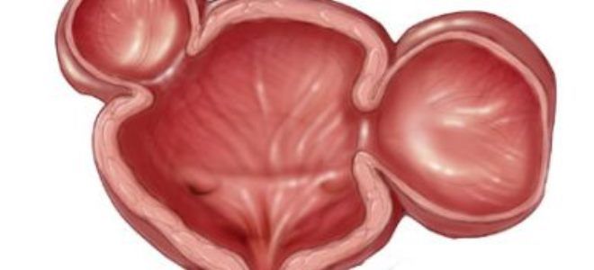 заболевания мочевого пузыря заболевания мочевого пузыря