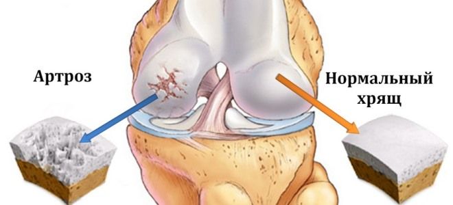 хондроитин для суставов хондроитин для суставов