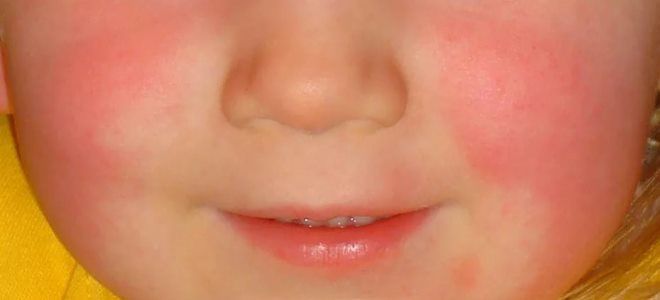 как определить скарлатину как определить скарлатину