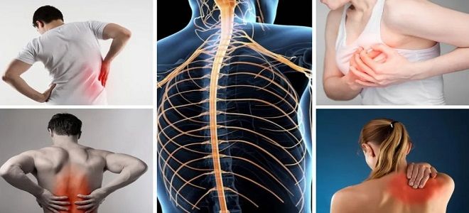 межреберная невралгия у беременных межреберная невралгия у беременных