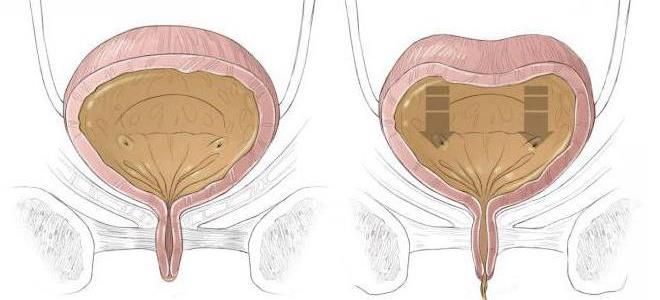 патологии мочевого пузыря патологии мочевого пузыря