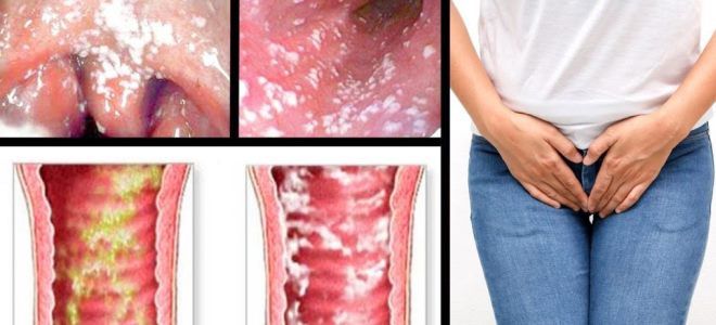 препарат флюкостат препарат флюкостат