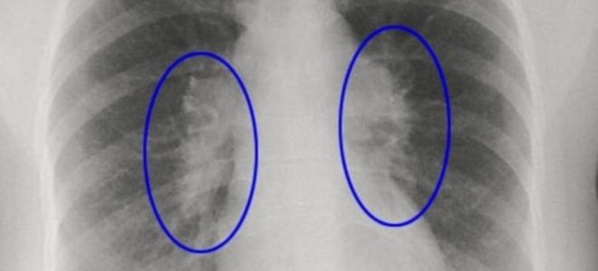 причины фиброза легких причины фиброза легких