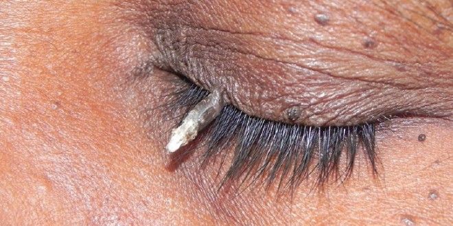 роговая кератома роговая кератома