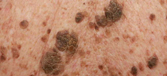 Себорейная кератома Себорейная кератома