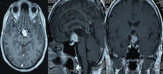 сифилис мозга это сифилис мозга это