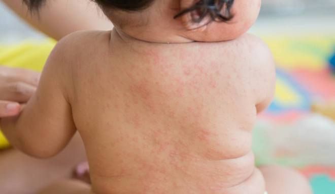 сыпь при розеоле сыпь при розеоле