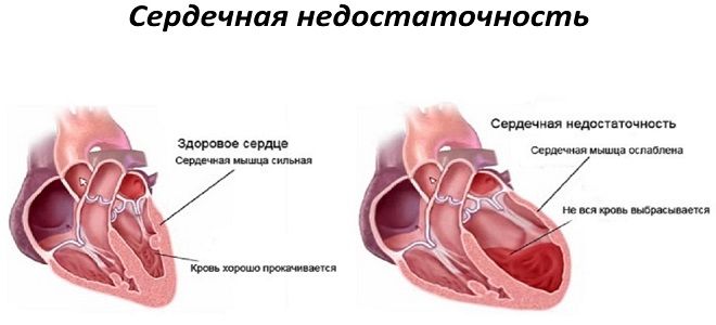 виды сердечной недостаточности виды сердечной недостаточности