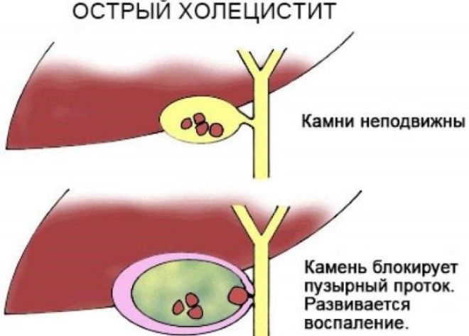 воспаление желчного пузыря симптомы воспаление желчного пузыря симптомы
