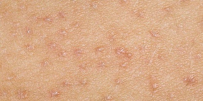 фоликулярная кератома фоликулярная кератома