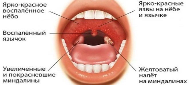 герпесная гнойная ангина герпесная гнойная ангина