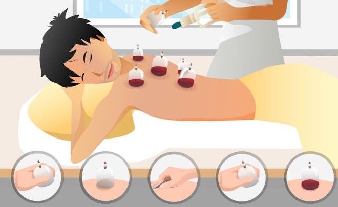 как делать хиджаму как делать хиджаму