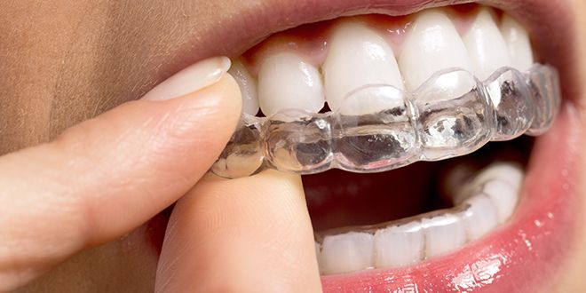 капа при бруксизме капа при бруксизме