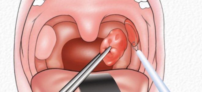 лечение ангины у детей лечение ангины у детей