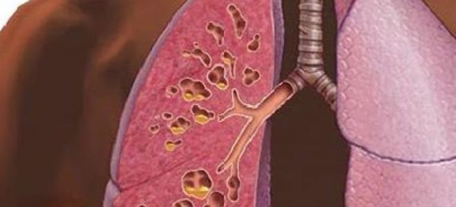 легочный фиброз легочный фиброз